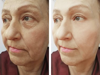 Yaşlı bir kadının yüz kırışıklıklar önce ve sonra yordamları