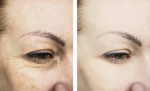 Rugas Nos Olhos Femininos Antes Depois Dos Tratamentos — Fotografia de Stock