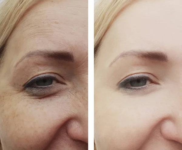 Ojos Femeninos Arrugas Antes Después Los Procedimientos — Foto de Stock