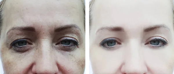 Rugas Nos Olhos Femininos Antes Depois Dos Procedimentos — Fotografia de Stock