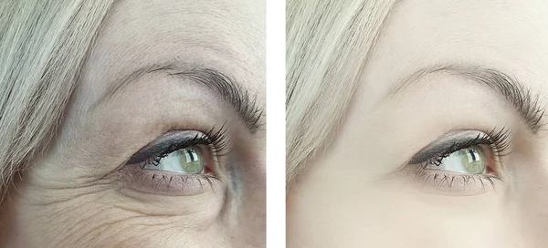 female eye wrinkles before and after treatments