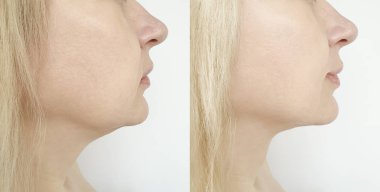woman chin before and after procedure clipart