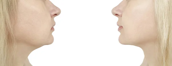 Woman Chin Procedure — Stock Photo, Image