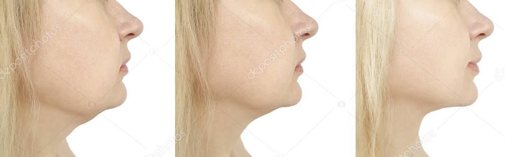 woman chin before and after procedure, retouching