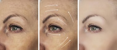 kadın kırışıklıklar önce ve yordamlar sonra ok