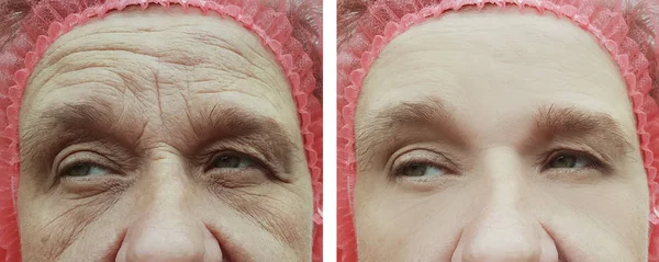 Стара Жінка Зморшки Після Процедур — стокове фото