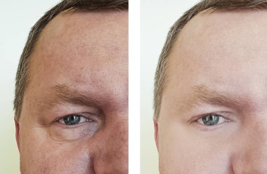 erkek göz kırışıklıkları öncesi ve sonrası yordamları