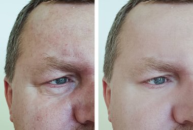 erkek göz kırışıklıkları öncesi ve sonrası yordamları