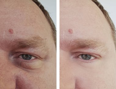 erkek göz kırışıklıkları öncesi ve sonrası yordamları