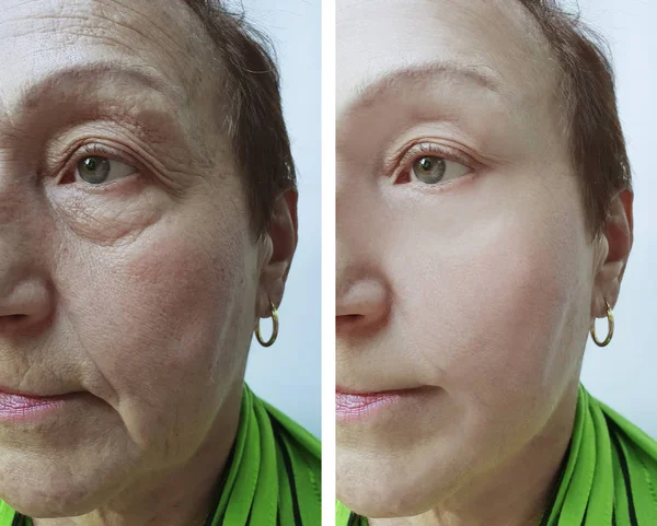 Elderly Woman Face Procedures — Stock Photo, Image