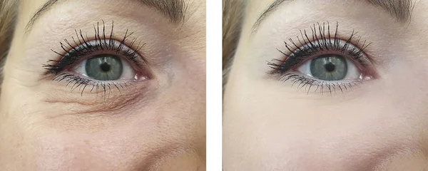 Olhos Uma Mulher Rugas Antes Depois Procedimentos — Fotografia de Stock