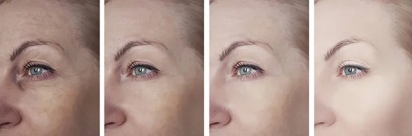 Woman Eye Wrinkles Procedures — Stock Photo, Image