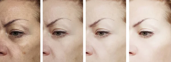 Γυναικεία Μάτια Ρυτίδες Πριν Και Μετά Τις Θεραπείες — Φωτογραφία Αρχείου