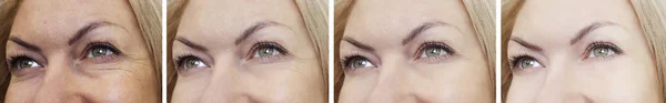 Female Eye Wrinkles Treatments — Stock Photo, Image