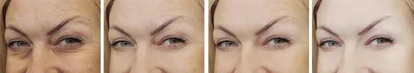 Γυναικεία Μάτια Ρυτίδες Πριν Και Μετά Τις Θεραπείες — Φωτογραφία Αρχείου