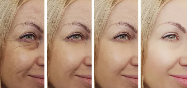woman face wrinkles after treatments