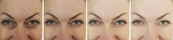 Arrugas Cara Mujer Después Tratamientos — Foto de Stock