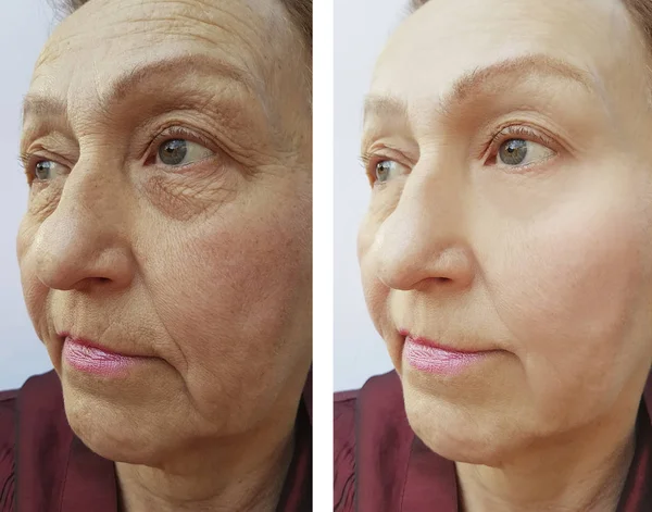 Морщины Лице Пожилой Женщины После Процедур — стоковое фото