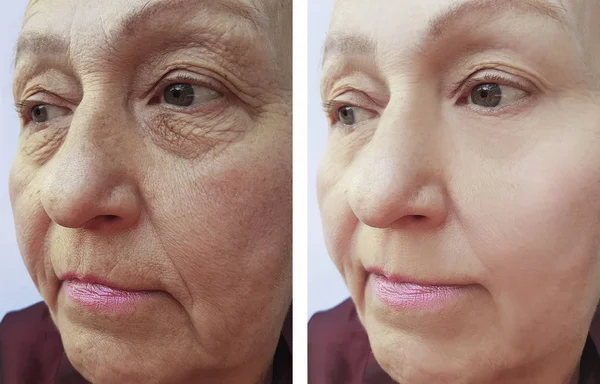 Arrugas Cara Mujer Anciana Antes Después Los Procedimientos — Foto de Stock