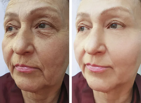 Arrugas Cara Mujer Anciana Antes Después Los Procedimientos — Foto de Stock