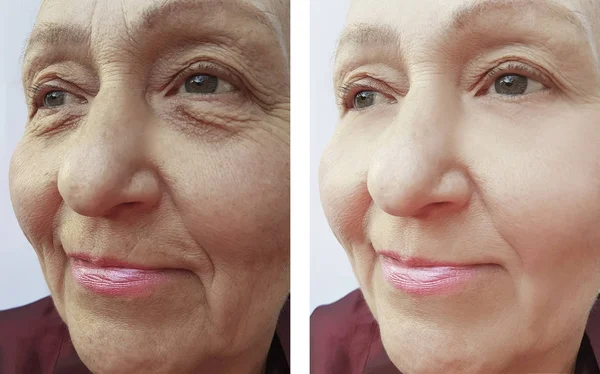 Elderly woman\'s face wrinkles before and after procedures