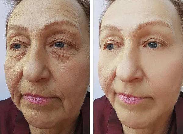 Arrugas Cara Mujer Anciana Antes Después Los Procedimientos — Foto de Stock