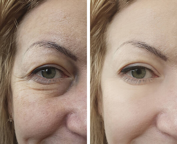 woman face wrinkles after treatments