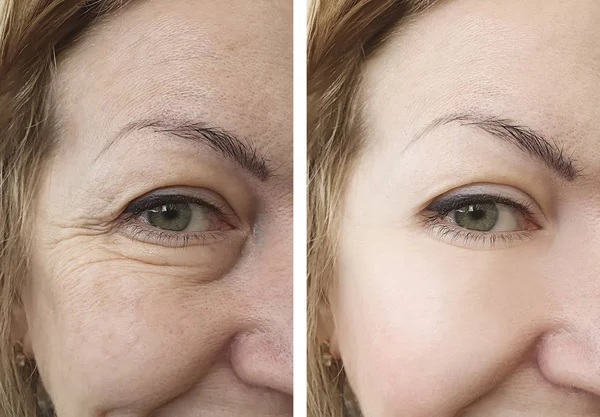 Arrugas Cara Mujer Después Tratamientos —  Fotos de Stock