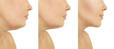 kadın çift çene yordamlar sonra