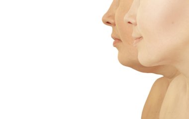 woman double chin after procedures clipart