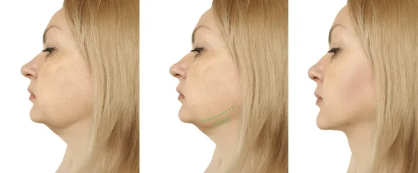 Woman Double Chin Procedures — Stock Photo, Image