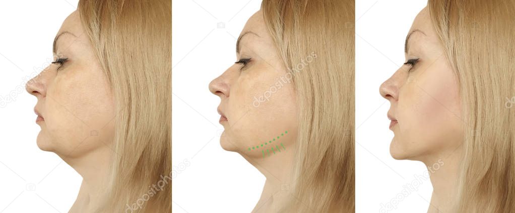 woman double chin before and after procedures