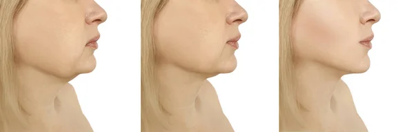 Woman Double Chin Procedures — Stock Photo, Image