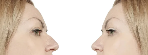 Female Nose Hump Procedures — Stock Photo, Image