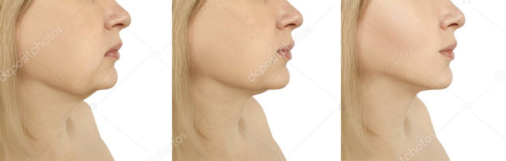 woman double chin before and after procedures