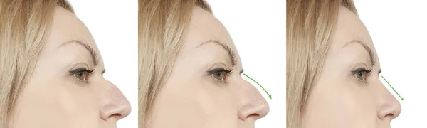 Жіночий Горб Носа Після Процедур — стокове фото