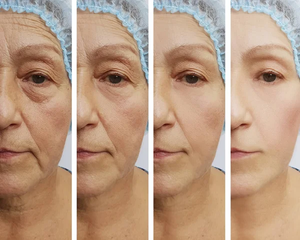 Old Woman Wrinkles Treatments — Stock Photo, Image