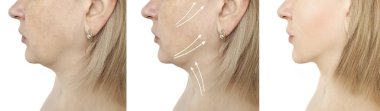 woman tightening the chin before and after the procedure clipart