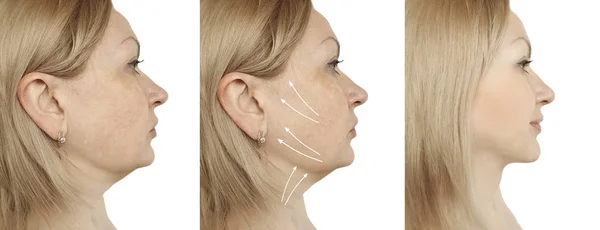 Woman Double Chin Lift Procedures — Stock Photo, Image