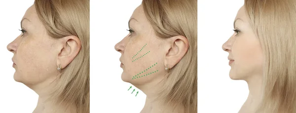 Woman Double Chin Lift Procedures — Stock Photo, Image