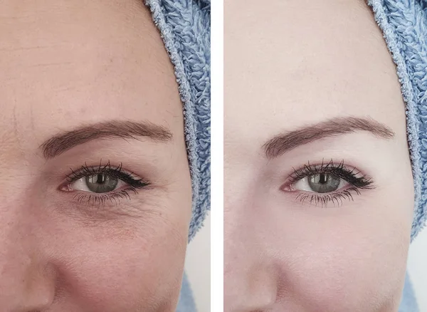 Female Eyes Wrinkles Treatments — Stock Photo, Image