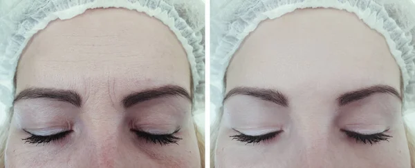 Female Forehead Wrinkles Treatments — Stock Photo, Image