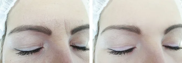 Weibliche Stirnfalten Vor Und Nach Der Behandlung — Stockfoto