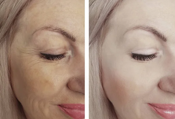 Arrugas Mujer Cara Antes Después Los Tratamientos —  Fotos de Stock