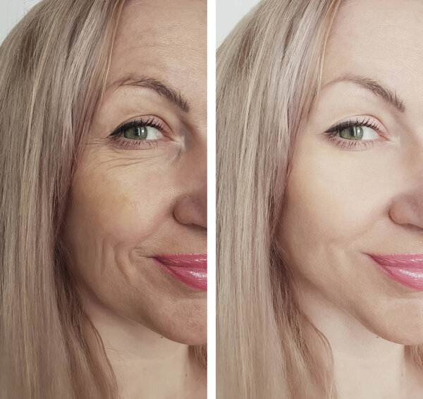 woman wrinkles face before and after treatments
