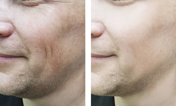 Ανδρικό Πρόσωπο Ρυτίδες Πριν Και Μετά Τις Θεραπείες — Φωτογραφία Αρχείου