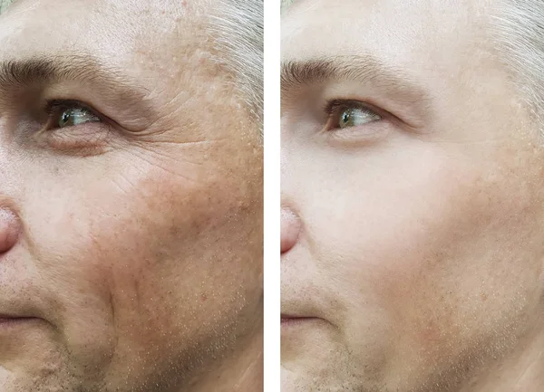 Male Face Wrinkles Treatments — Stock Photo, Image