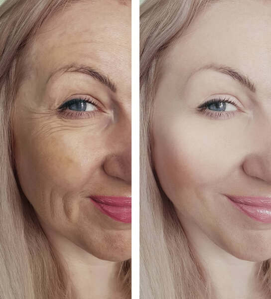 woman face wrinkles before and after treatments