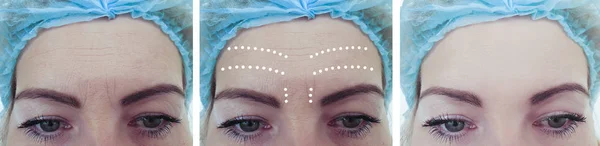 Wanita Keriput Wajah Sebelum Dan Sesudah Perawatan — Stok Foto