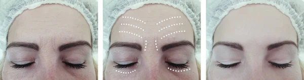 女性皱纹在治疗前后的脸 — 图库照片